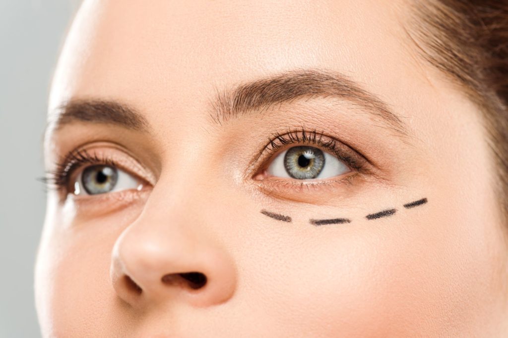 Blépharoplastie supérieure et inférieure